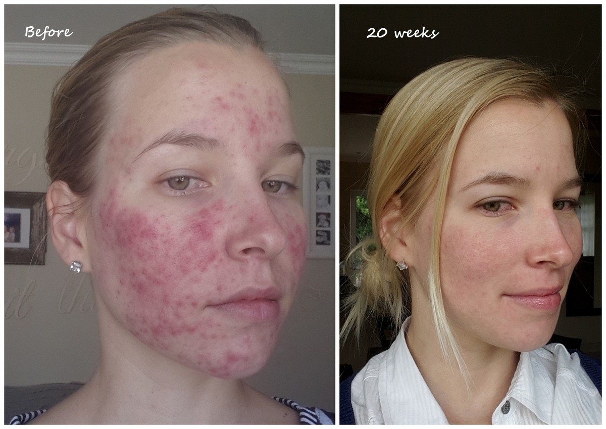 Roaccutane Progress - 20 Weeks (Just Over Half Way) - 3 Kids, 2 Dogs ...